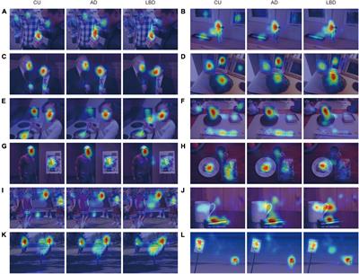 Distinct eye movement patterns to complex scenes in Alzheimer’s disease and Lewy body disease